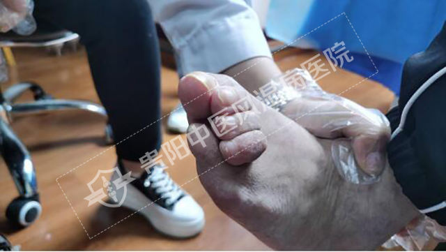 類風濕導致的指關節(jié)畸形殘疾2.jpg