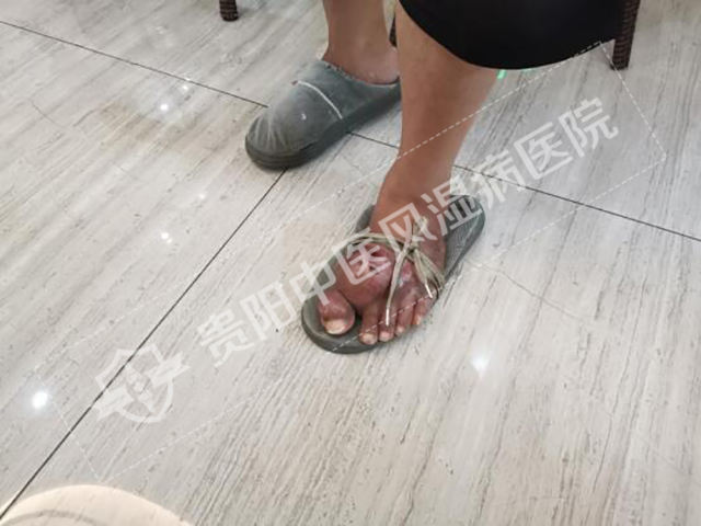 痛風性關節(jié)炎導致無法正常穿鞋1.jpg