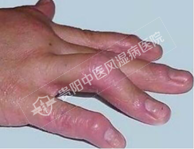 骨關節(jié)炎導致的關節(jié)腫脹1.jpg