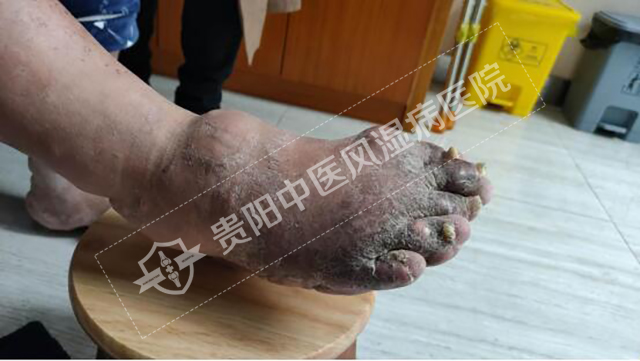 痛風性關節(jié)炎導致無法正常穿鞋2.jpg